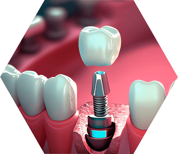 Имплантация