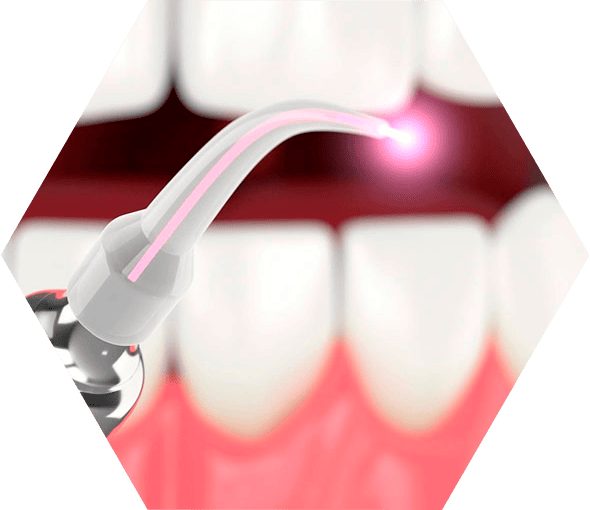 Лазерная стоматология